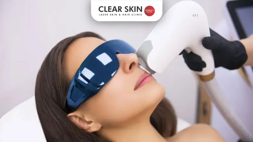 Unlock the Power of IPL Laser for Melasma Treatment Clear Skin Pune