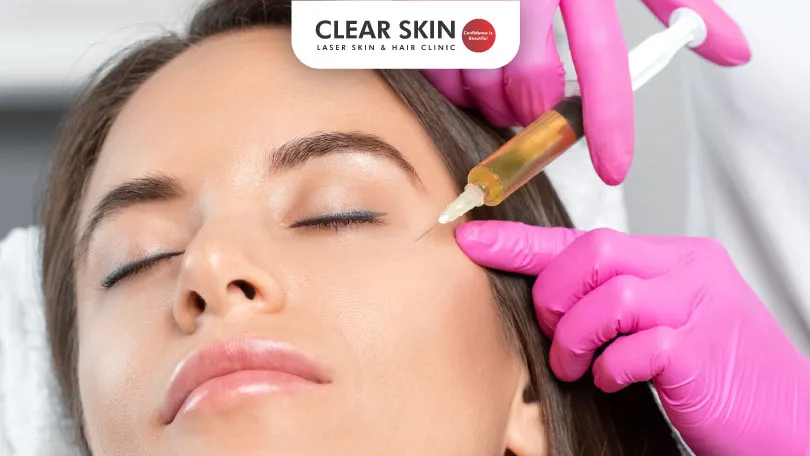 Benefits of PRP Therapy for Melasma