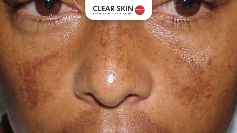 Unveiling-the-Power-of-Homeopathy for Melasma Treatment clear skin pune 