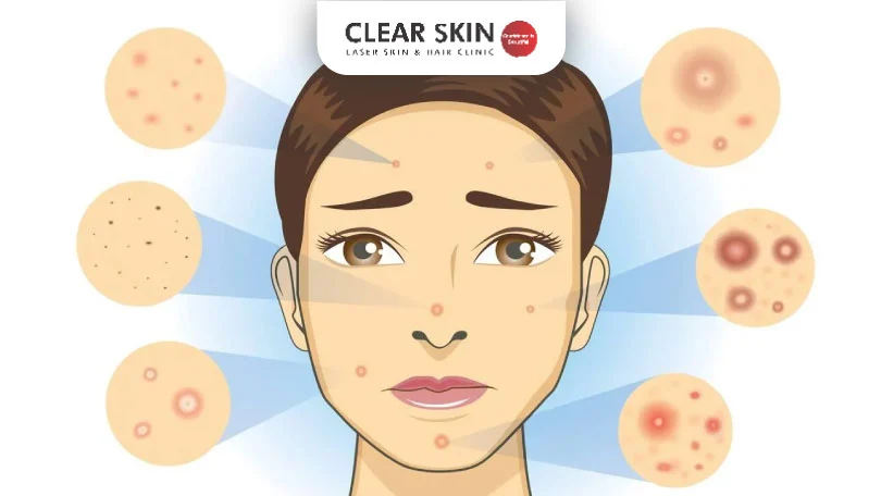 Various Types of Acne: Causes, Symptoms, and Treatments