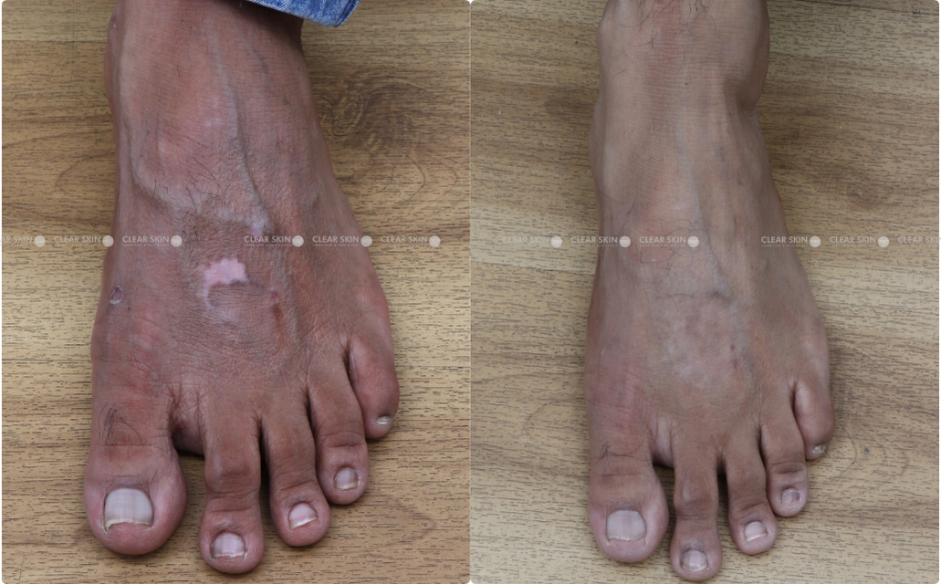 Vitiligo Results 4 Sessions 5 Months ClearSkin Pune