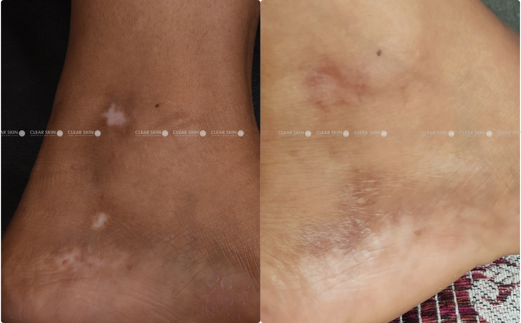 Vitiligo Results 6 Sessions 5 Months ClearSkin Pune