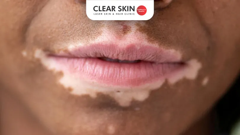 Decoding Vitiligo on Lips: Causes, Treatments, and Expert Insights!