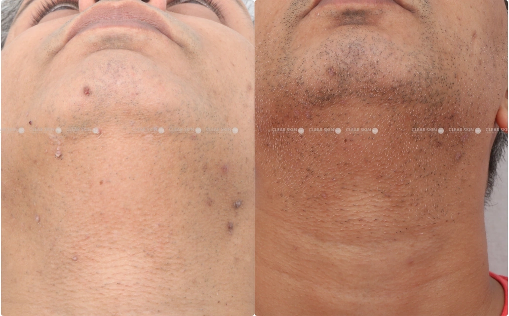 Wart Removal Results 1 Sessions 1 Months ClearSkin Pune