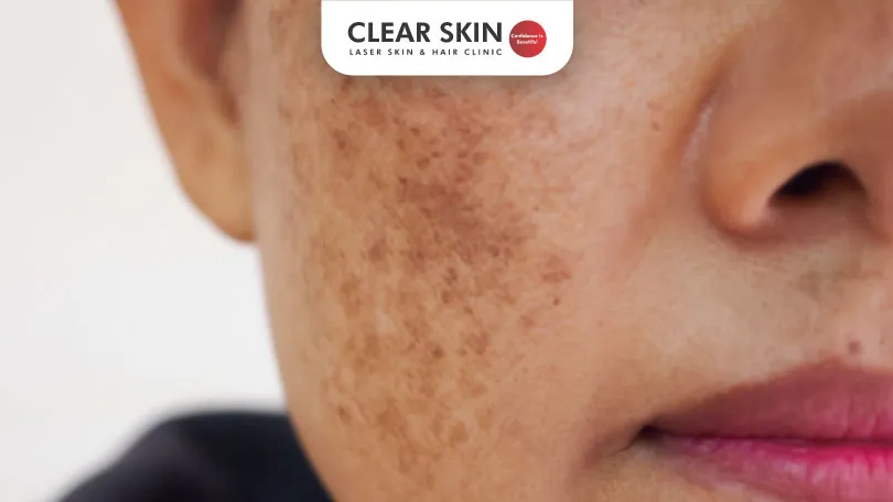 What Does Dermal Melasma Look Like Clear Skin Pune