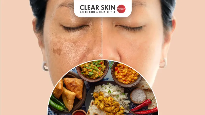 What Foods Cause Melasma?