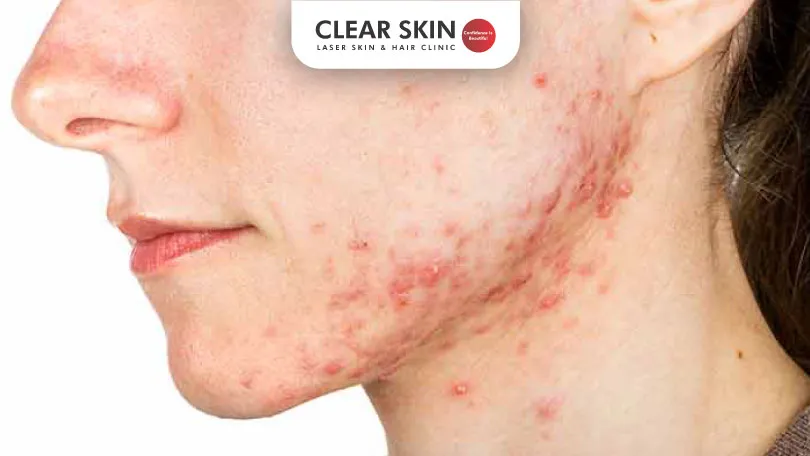 Severe Acne: Causes And Treatment