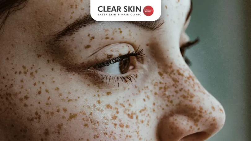 What are Freckles? | Clear Skin, Pune