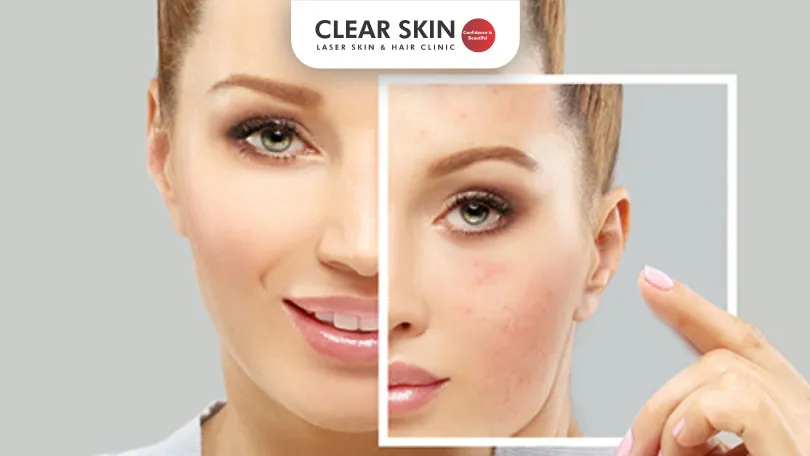 Effective Oral Treatments for Melasma | Clear Skin Clinic