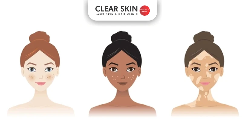 Types of Skin Pigmentation