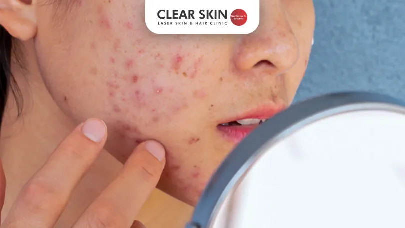 What is Acne-Prone Skin? Understanding Causes & Treatments