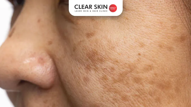 What is melasma pigmentation?