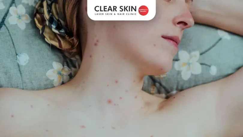 How much does chicken pox scar removal cost ?