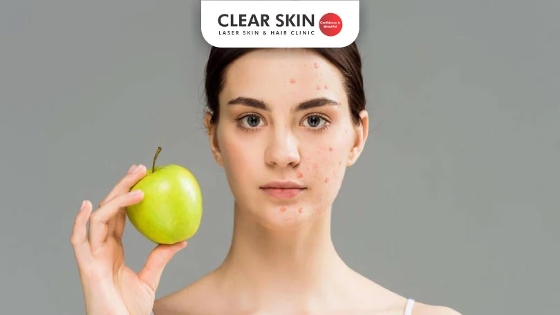 What is the link between Acne and Diet?