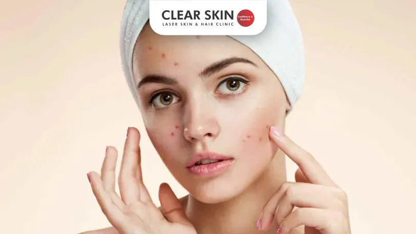 Why My Acne Is Not Going Away Clear Skin Pune