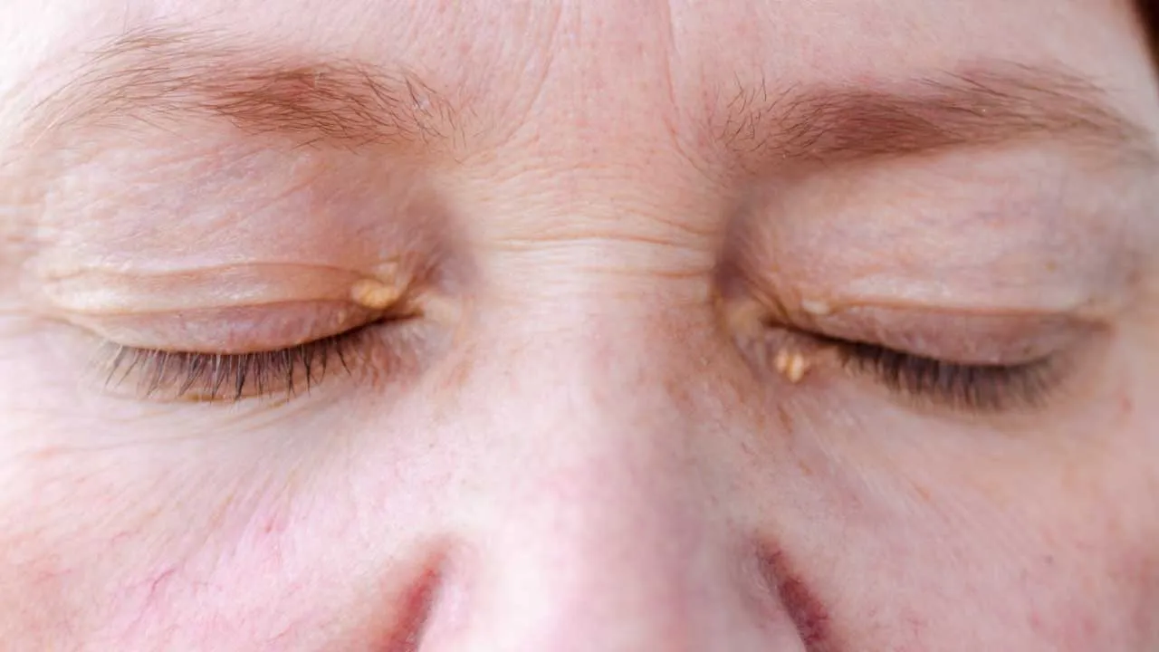 Xanthelasma