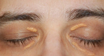 Yellow Patches Near Eyelids