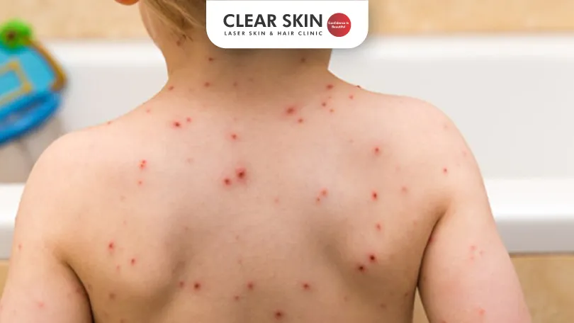 Chicken Pox Overview