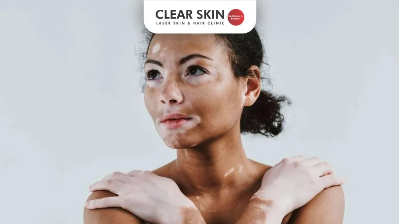 कोड रोग (Vitiligo) लक्षणे, कारणे व उपचार Clear Skin Pune