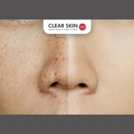 Effective Home Remedies for Skin Pigmentation