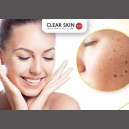 Best Treatments for Pigmentation on Face