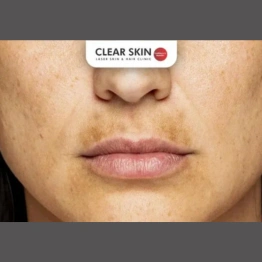 Treating Melasma Around the Mouth