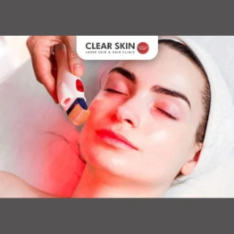 Red Light Therapy for Melasma