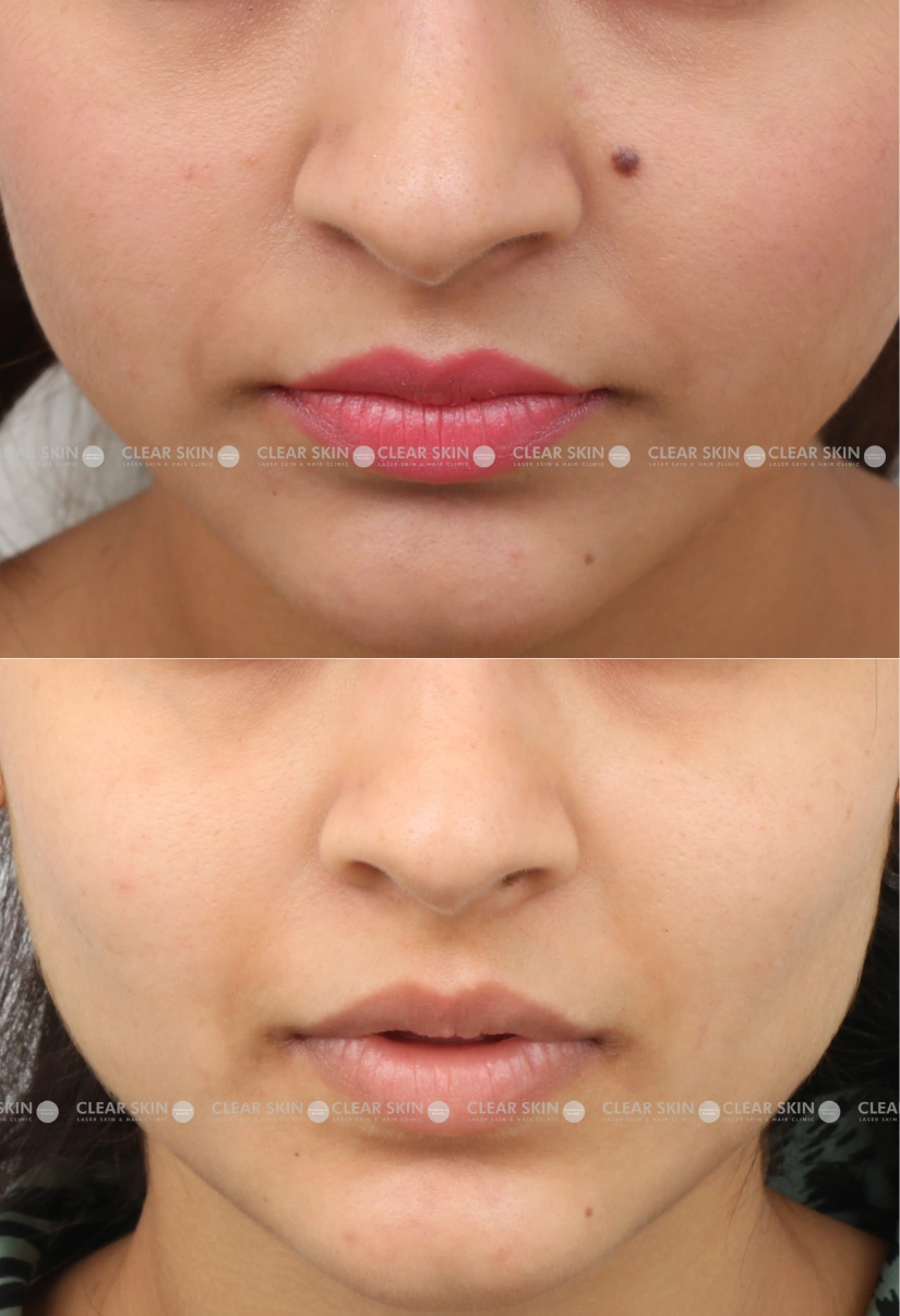 20yrs Female Mole Removal Results 2 Months Timeline 2 Sessions ClearSkin Pune