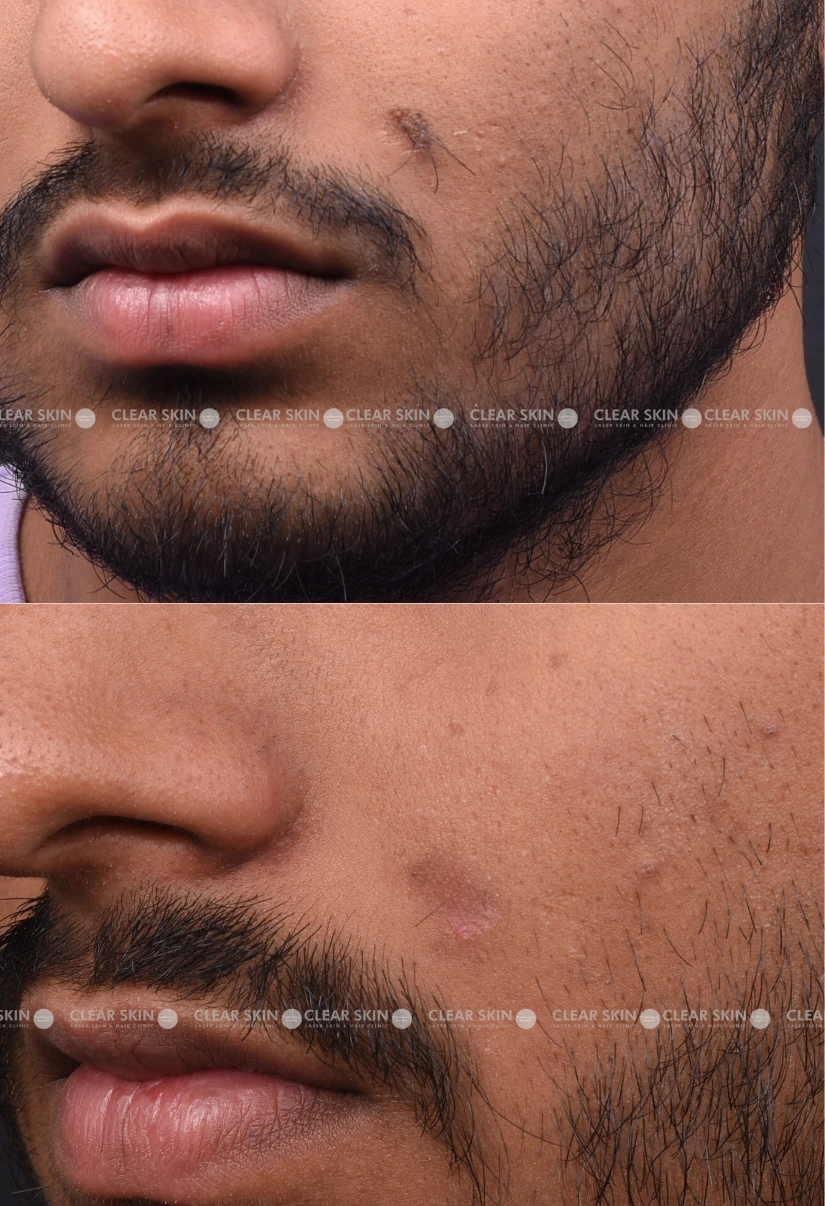 20yrs male Mole Removal Results 1 Months Timeline 3 Sessions ClearSkin Pune