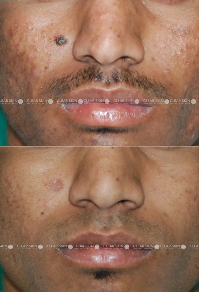 26yrs male Mole Removal Results 3 Months Timeline 2 Sessions ClearSkin Pune