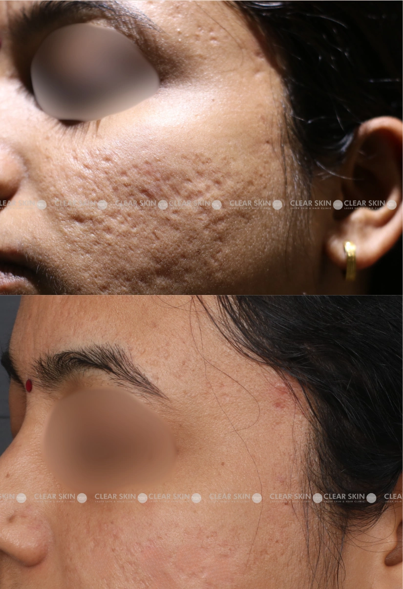 29yrs Female Acnescars Results 6 Months Timeline 6 Sessions ClearSkin Pune