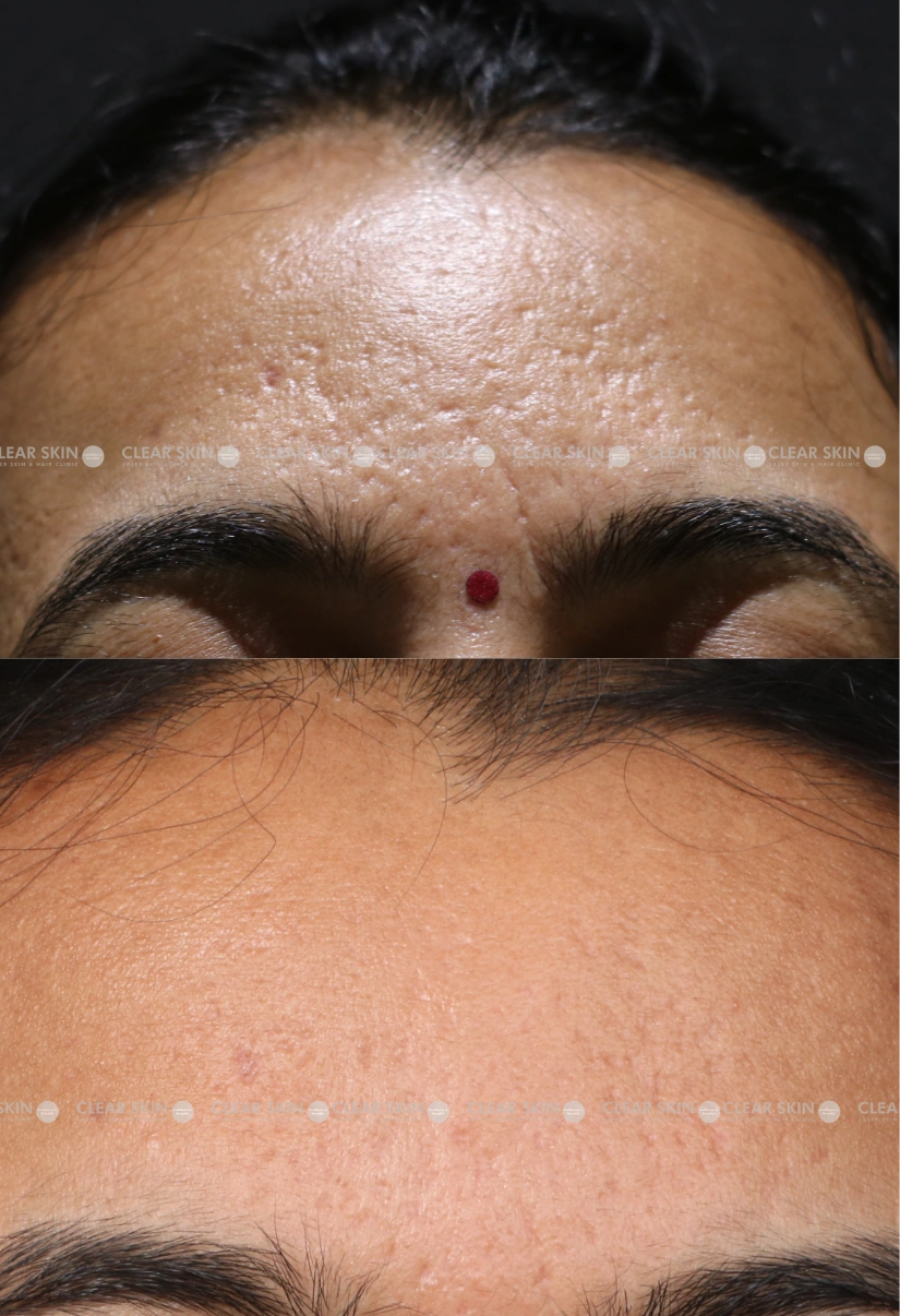 29yrs Female Acnescars Results 6 Months Timeline 6 Sessions ClearSkin Pune