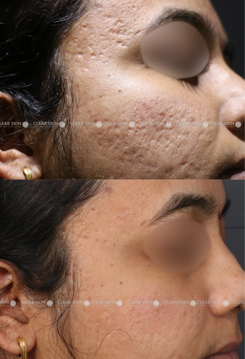 29yrs Female Acnescars Results 6 Months Timeline 6 Sessions ClearSkin Pune