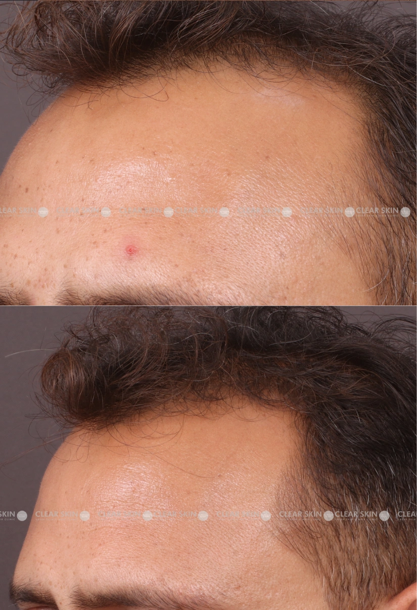 29yrs male Mole Removal Results 2 Months Timeline 2 Sessions ClearSkin Pune