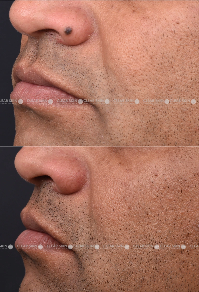 29yrs male Mole Removal Results 2 Months Timeline 3 Sessions ClearSkin Pune