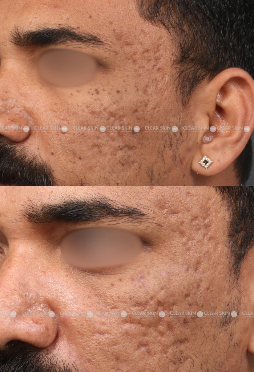 29yrs male Mole Removal Results 3 Months Timeline 2 Sessions ClearSkin Pune 