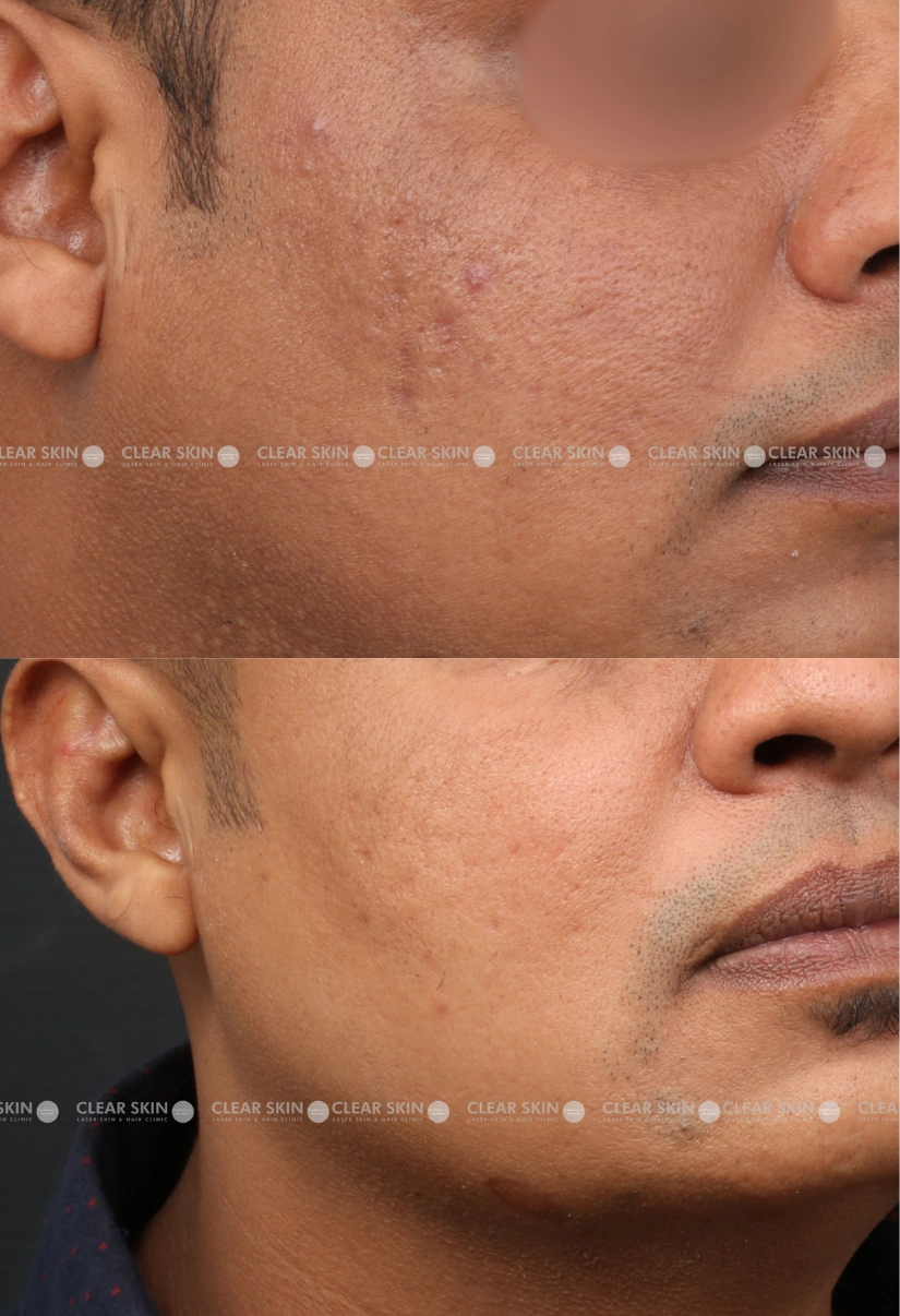 30yrs male Acnescars Results 3 Months Timeline 5 Sessions ClearSkin Pune