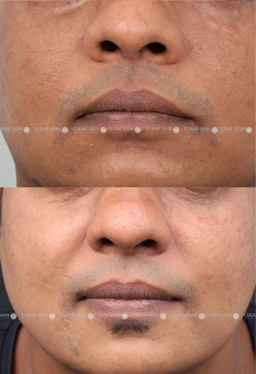 30yrs male Acnescars Results 3 Months Timeline 5 Sessions ClearSkin Pune