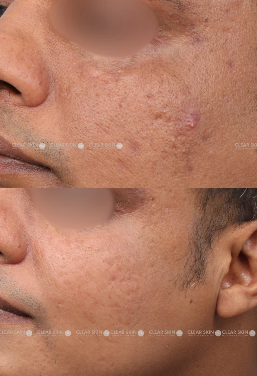 30yrs male Acnescars Results 3 Months Timeline 5 Sessions ClearSkin Pune