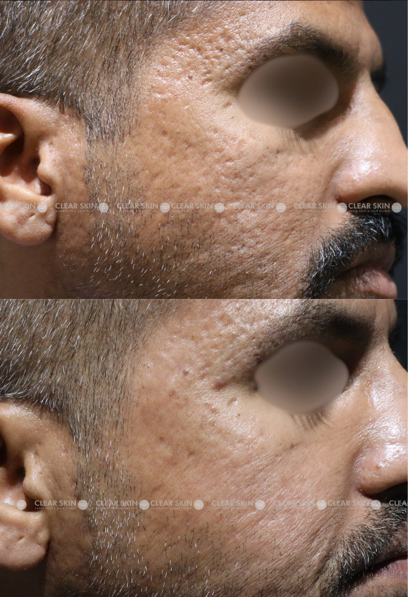 30yrs male Acnescars Results 4 Months Timeline 7 Sessions ClearSkin Pune