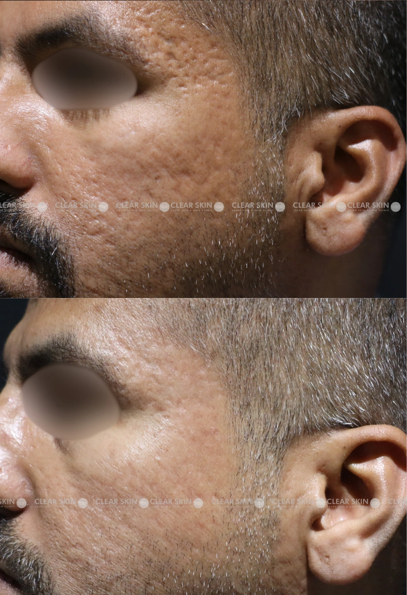 30yrs male Acnescars Results 4 Months Timeline 7 Sessions ClearSkin Pune