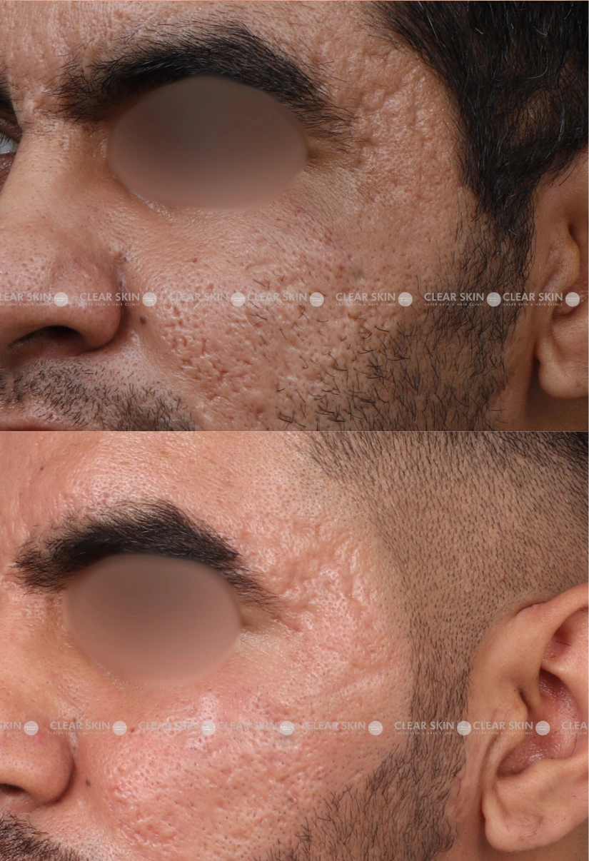 31yrs male Acnescars Results 4 Months Timeline 7 Sessions ClearSkin Pune