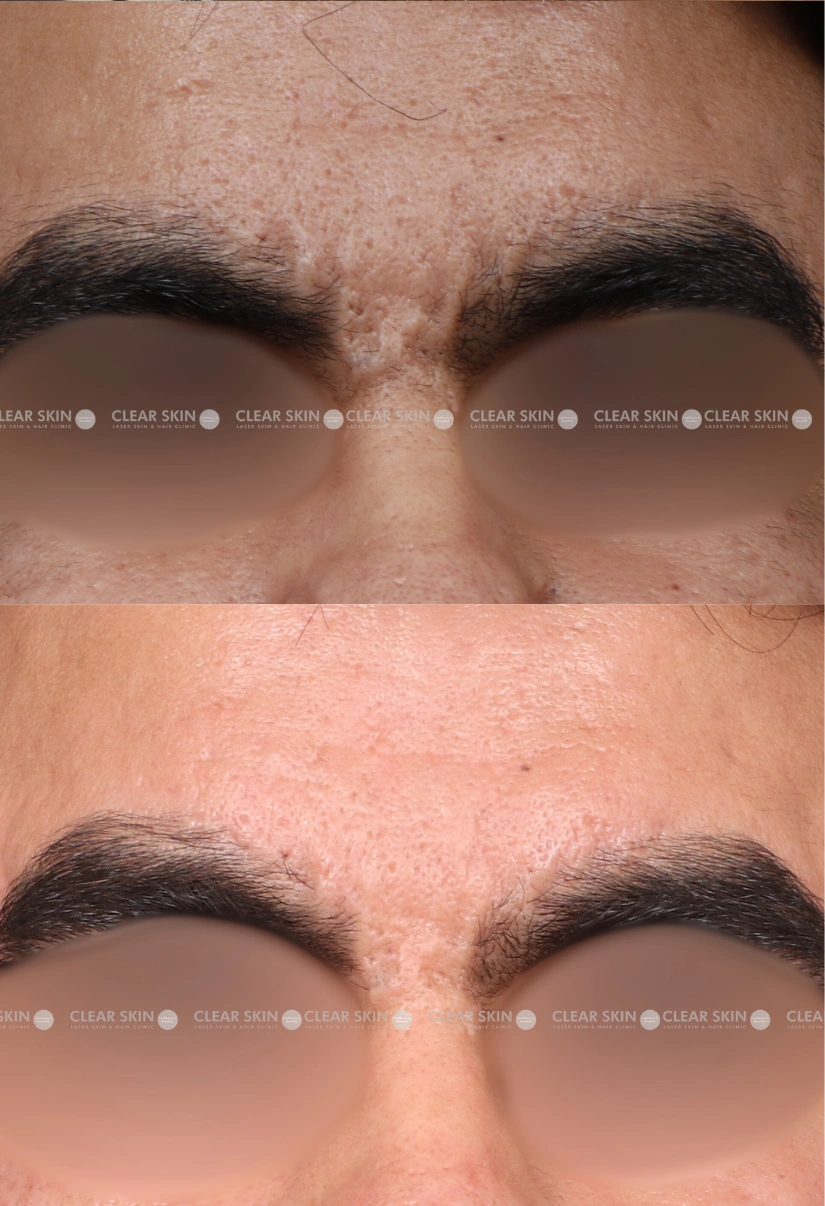 31yrs male Acnescars Results 4 Months Timeline 7 Sessions ClearSkin Pune