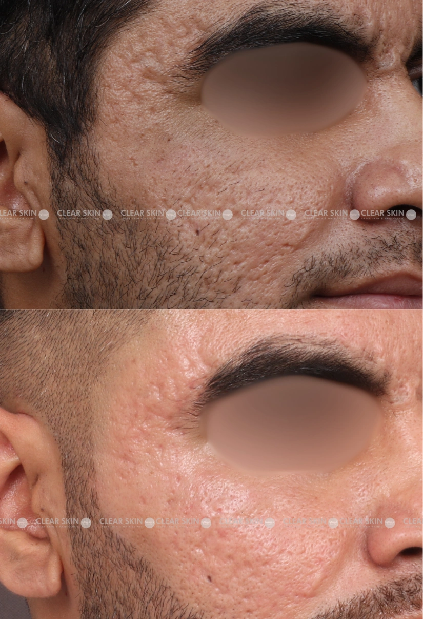 31yrs male Acnescars Results 4 Months Timeline 7 Sessions ClearSkin Pune