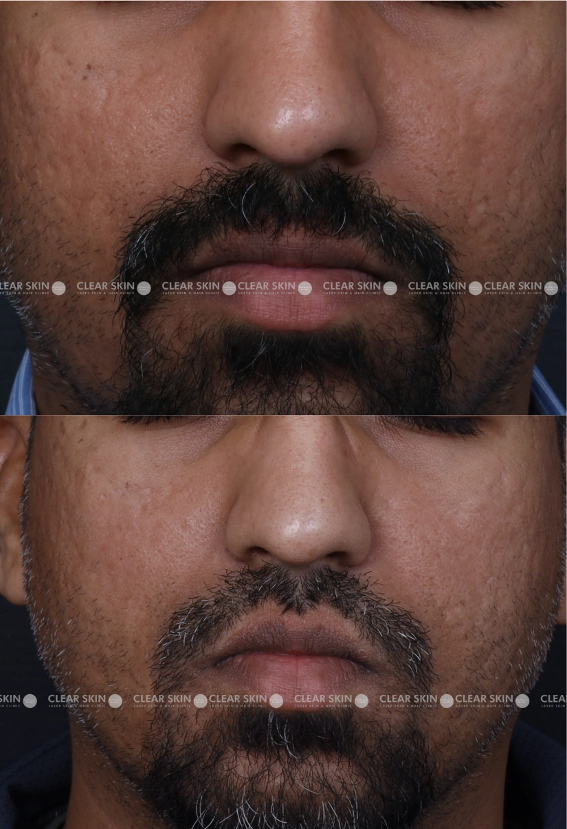 31yrs male Acnescars Results 5 Months Timeline 7 Sessions ClearSkin Pune