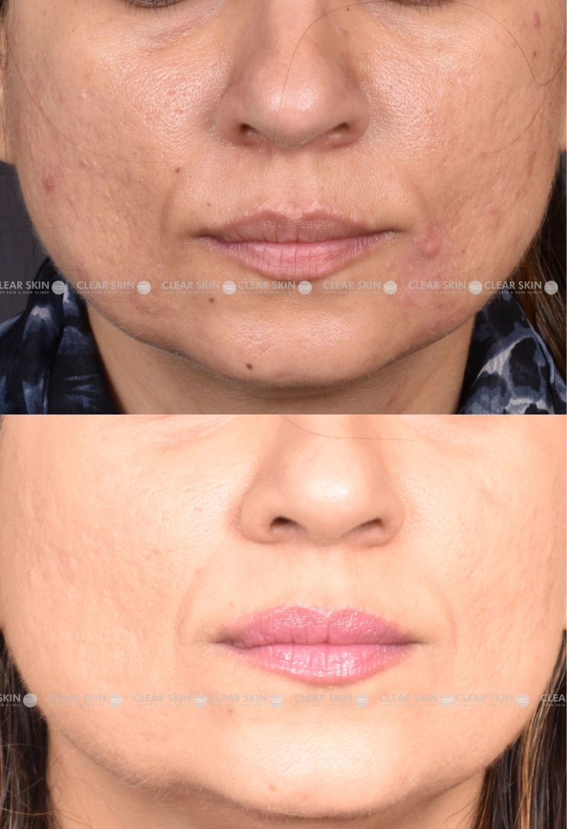 32yrs Female Acnescars Results 4 Months Timeline 7 Sessions ClearSkin Pune