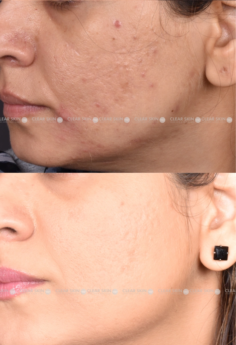 32yrs Female Acnescars Results 4 Months Timeline 7 Sessions ClearSkin Pune