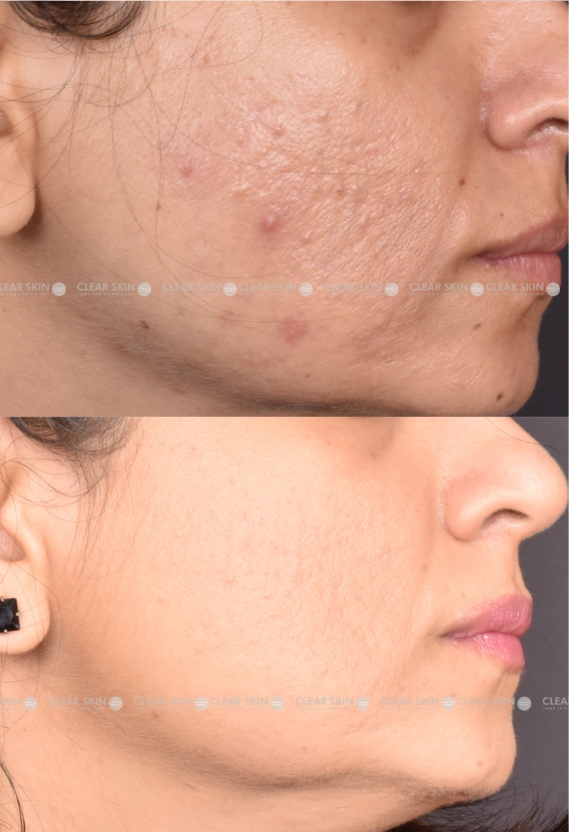 32yrs Female Acnescars Results 4 Months Timeline 7 Sessions ClearSkin Pune