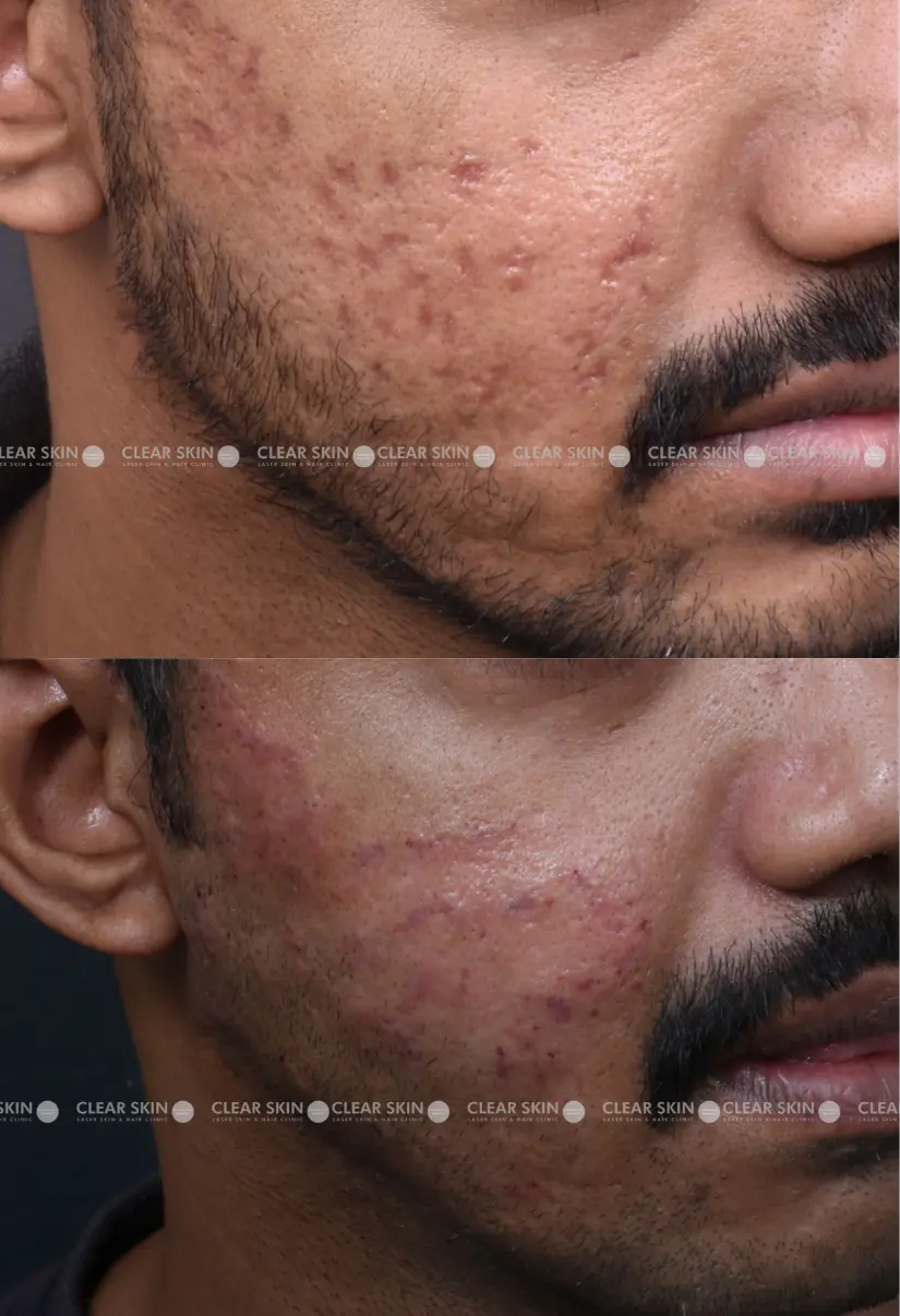 34yrs male Acnescars Results 4 Months Timeline 7 Sessions ClearSkin Pune