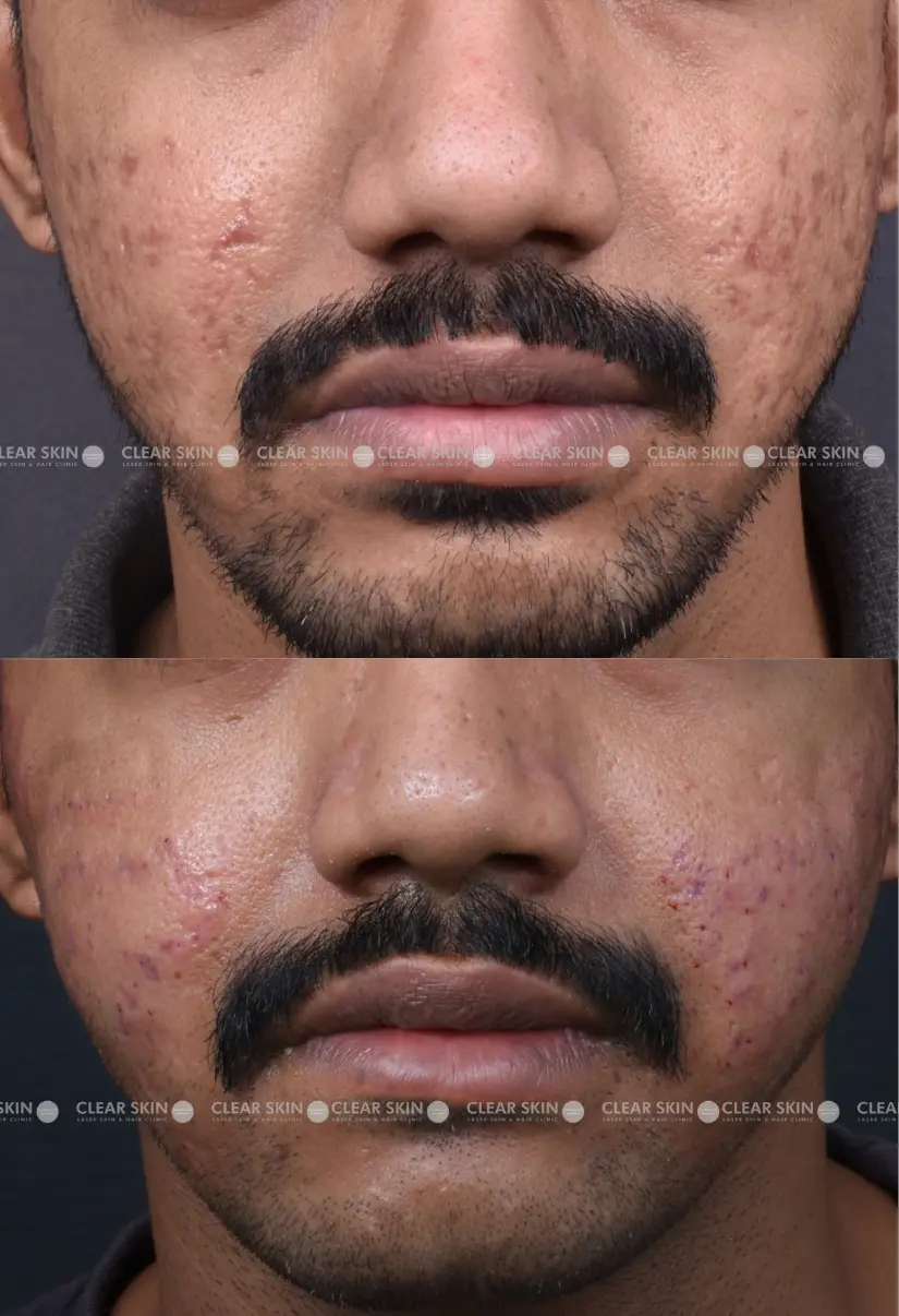 34yrs male Acnescars Results 4 Months Timeline 7 Sessions ClearSkin Pune